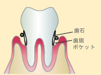 中等度歯周炎